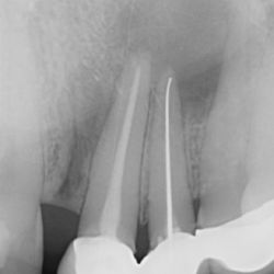 Avant la reprise de traitement endodontique