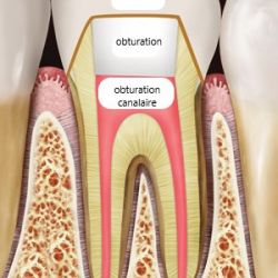 Dente traitée et guérie