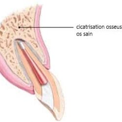 Dente traitée et guérie