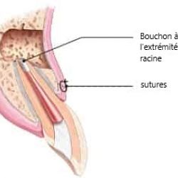 Dente infectée